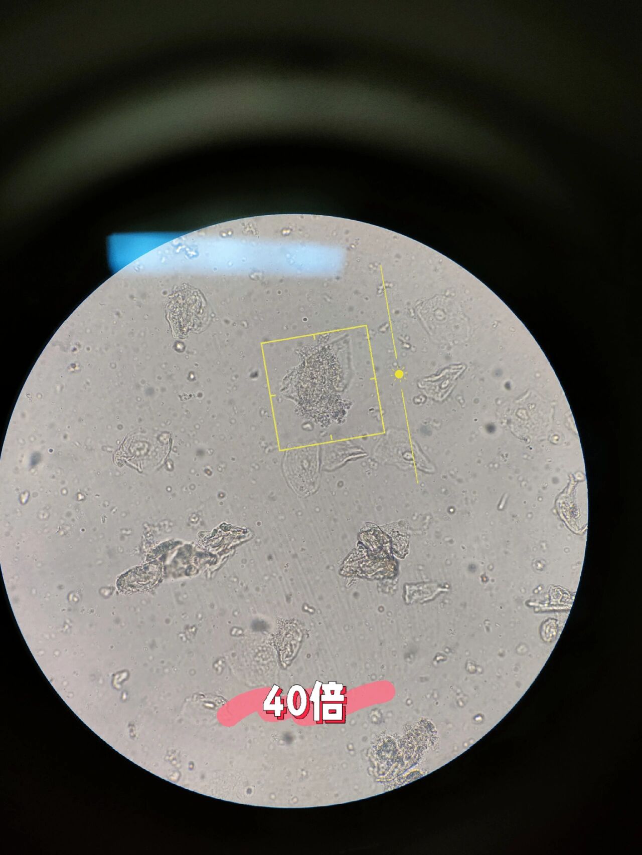 白带荧光之线索细胞 细菌性阴道炎(bv) 白带性状:分泌物增多,灰白色