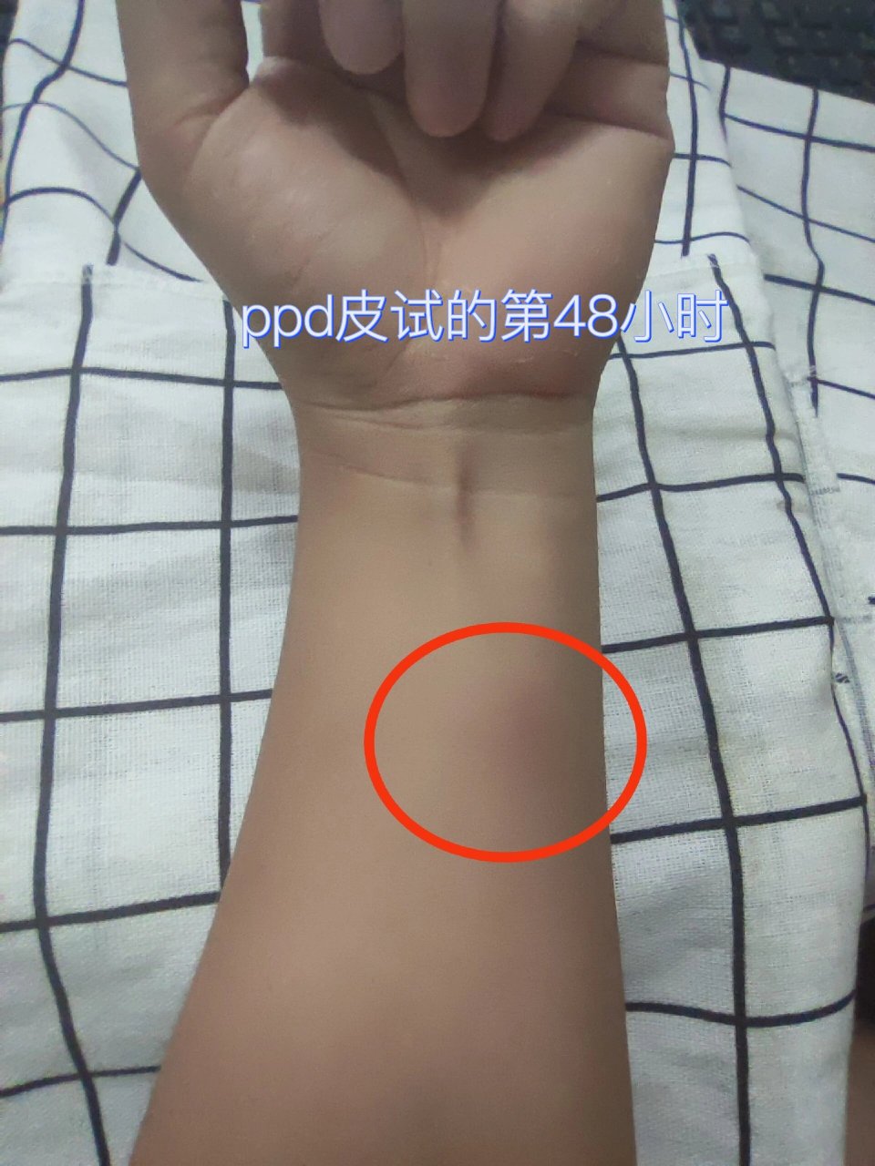 ppd皮试 ppd皮试的第48小时,现在触摸起来好像是有硬块,明天下午就要