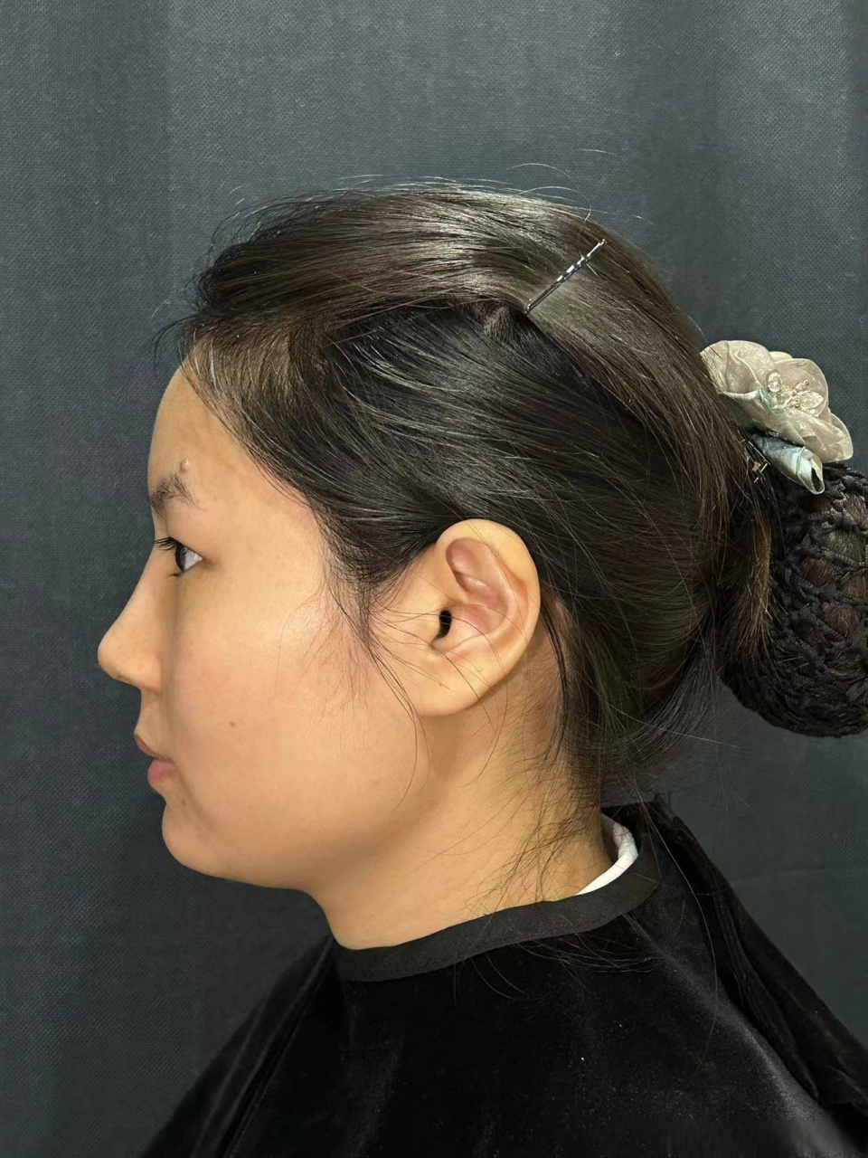 【真实案例分享】塌鼻子怎么样才能做出自然好看的妈生鼻  求美者术前