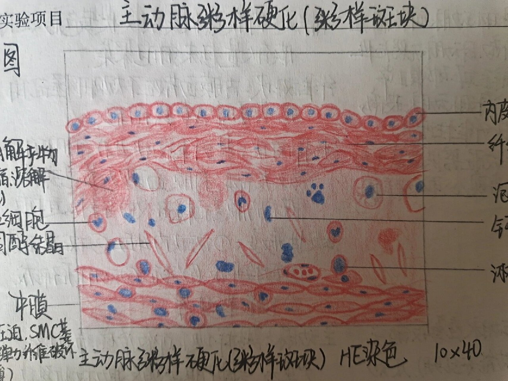 动脉粥样硬化切片图解图片