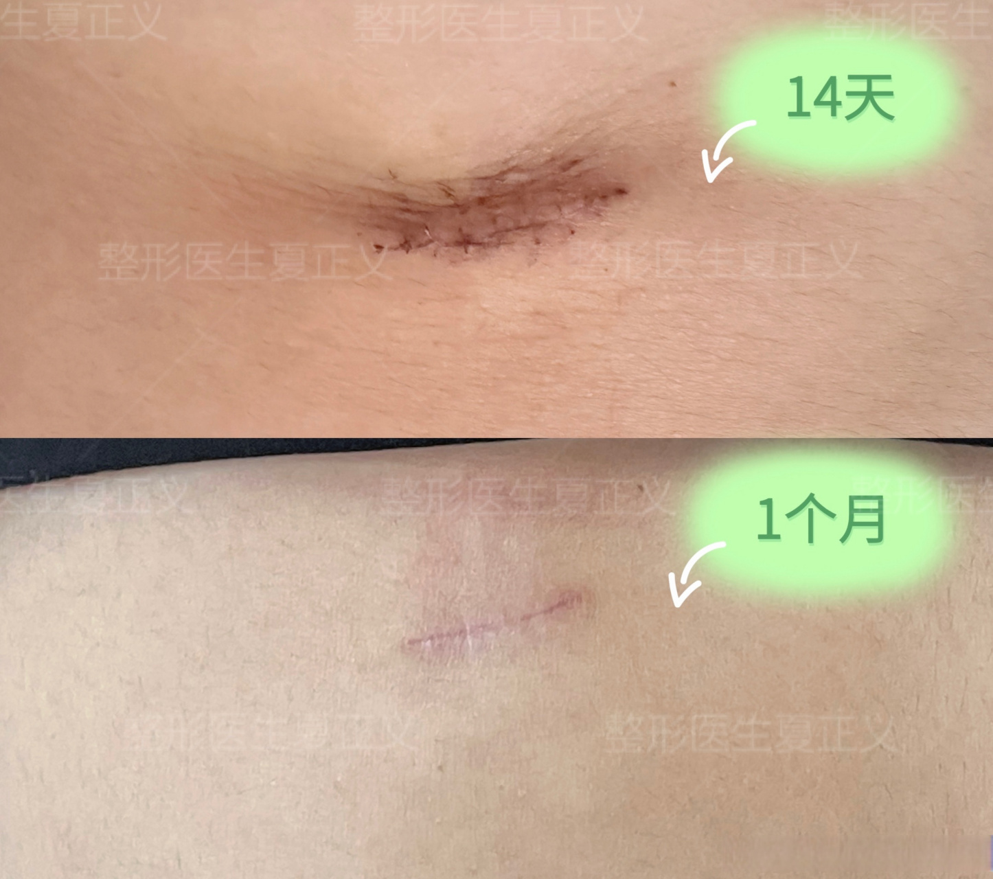 很多人美宝贝关心肋软骨术后切口瘢痕问题,这是一个月后的切口形态