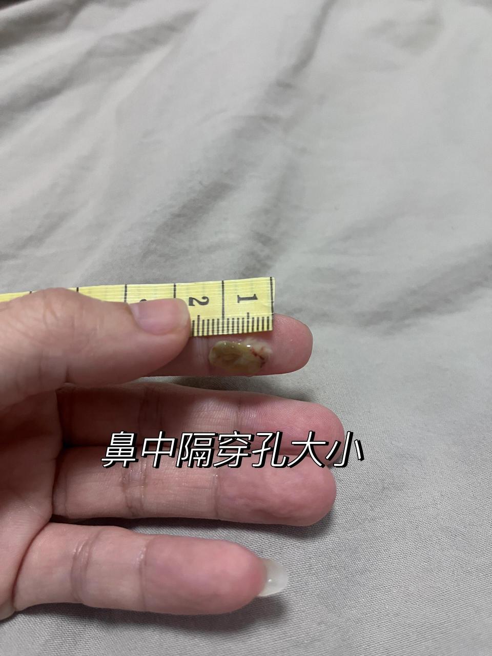 鼻中隔穿孔的大小 这是我昨天洗鼻子洗出来的结痂,是长在穿孔上的,我