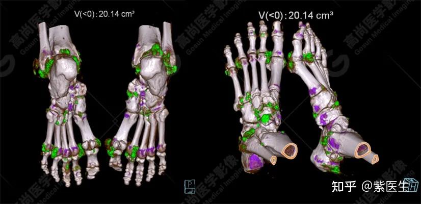 双源ct查痛风结晶图片图片