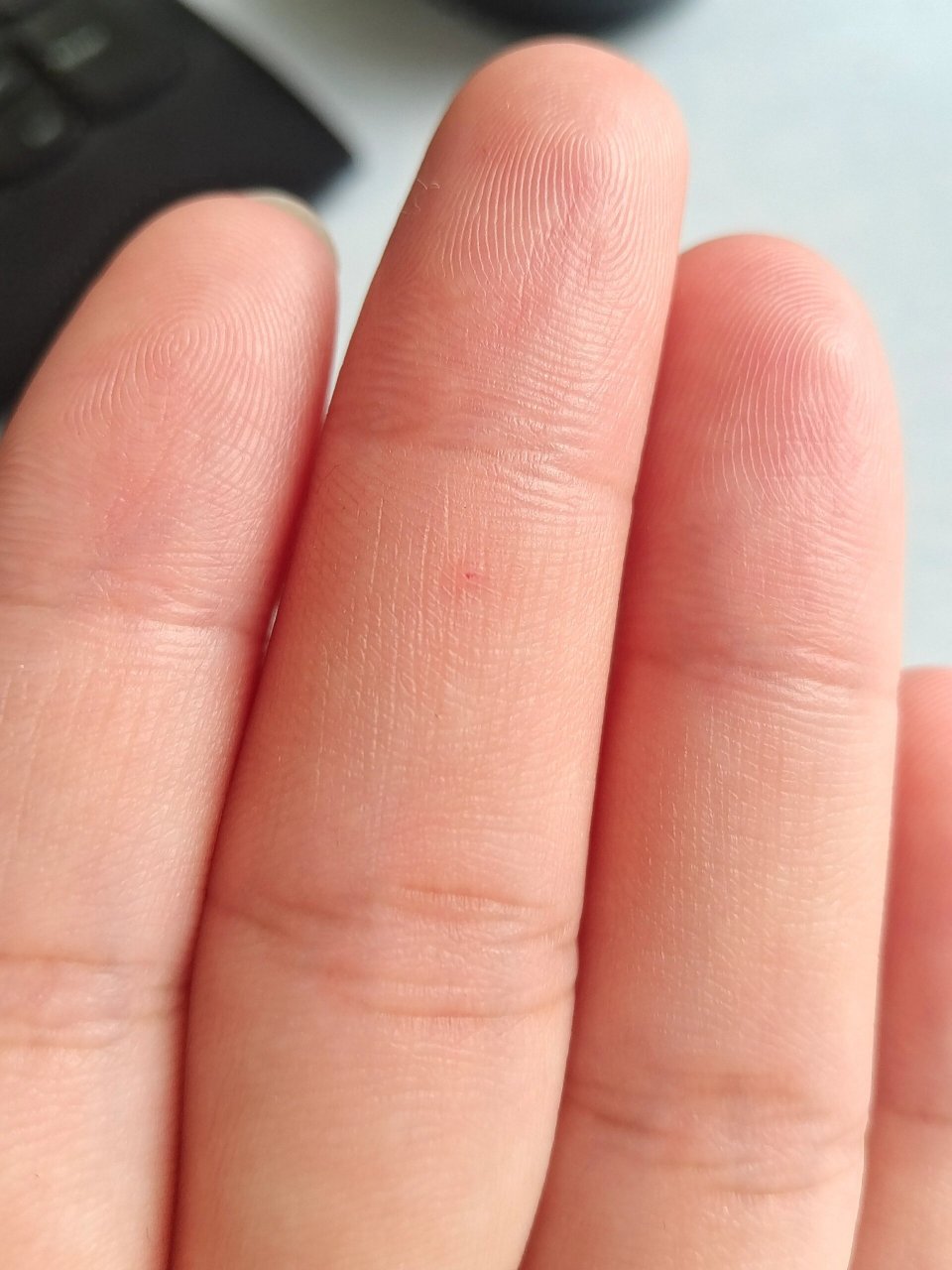 手心小红点在皮肤里面,不痛不痒