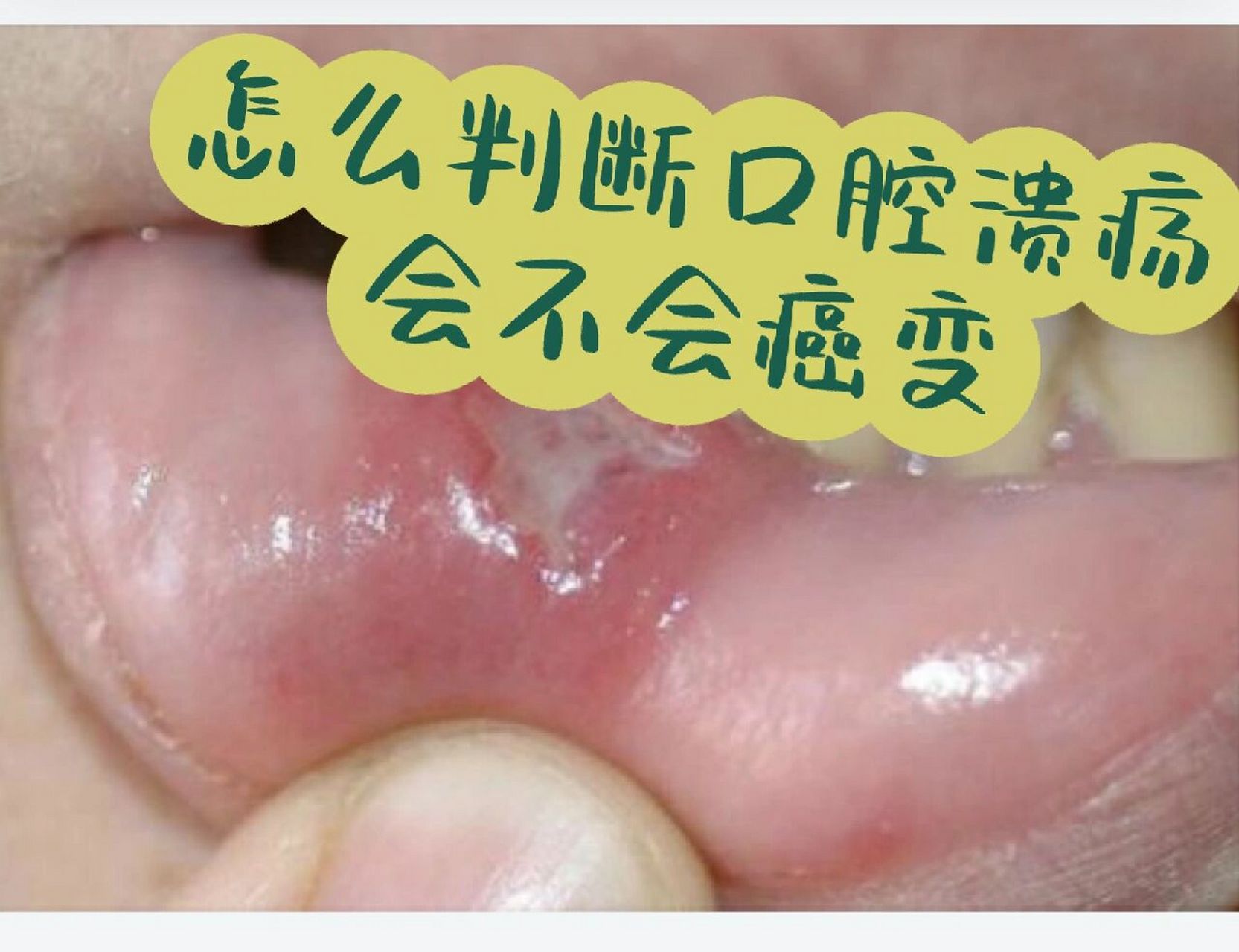 口腔溃疡六个症状判断是否为口腔癌 口腔溃疡一般不会变成口腔癌,但是
