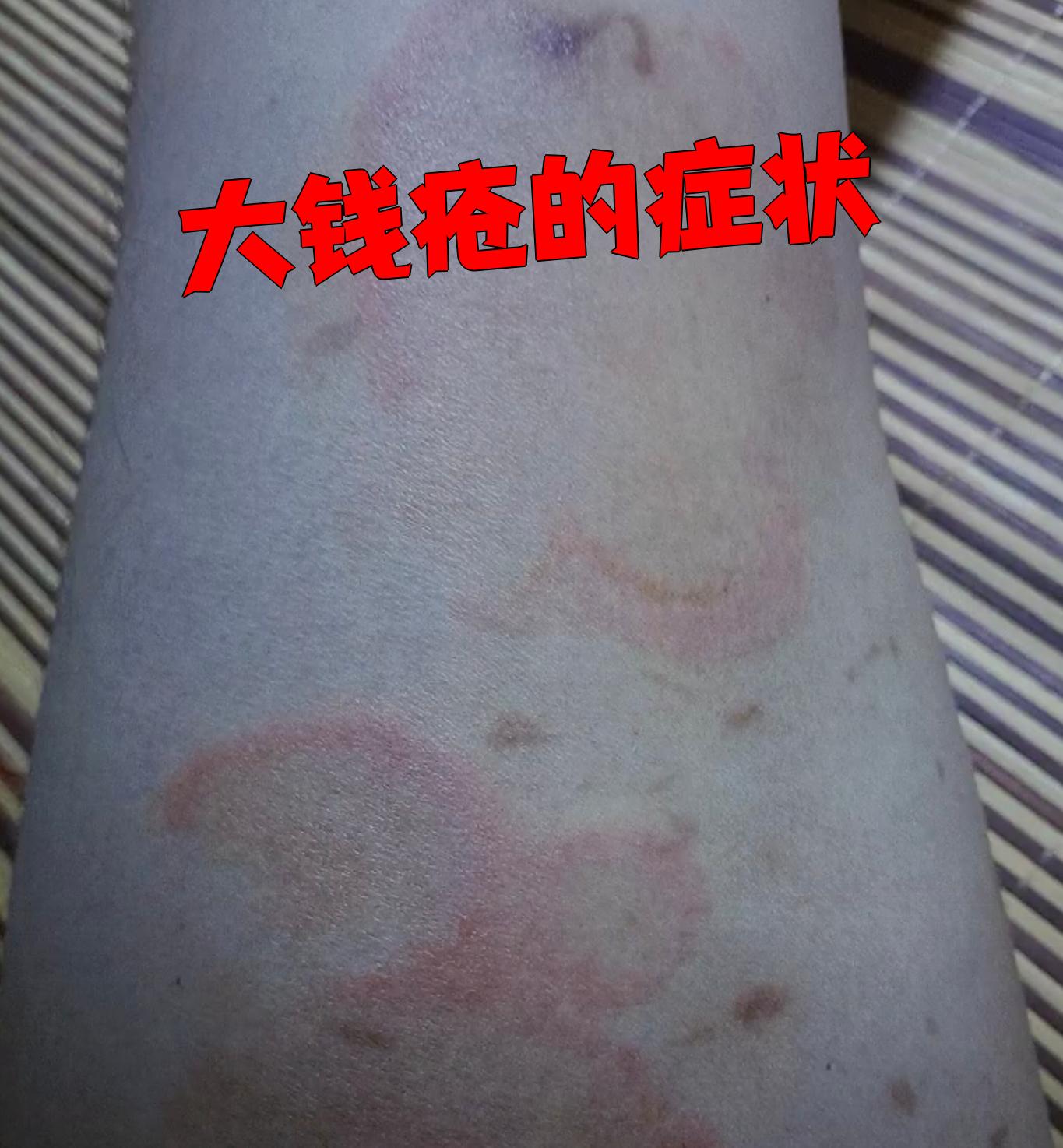 大钱疮,也称为钱币状湿疹,是一种常见的皮肤病,其症状