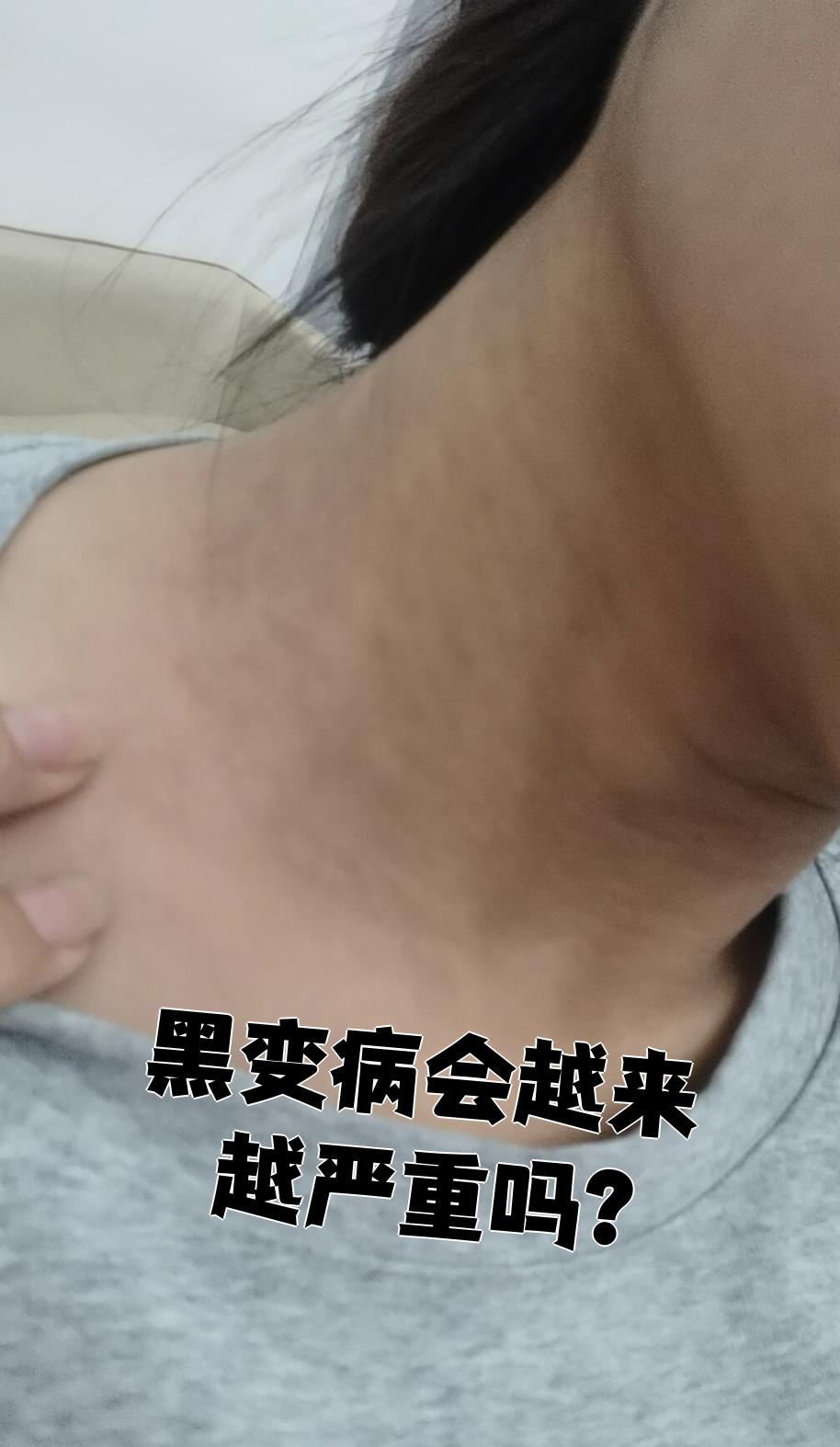 黑变病是一种主要发生在面颈部的皮肤病,特点是皮肤出现弥漫性色素