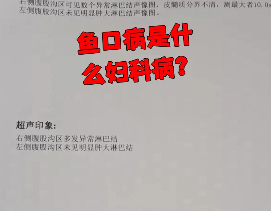 鱼口病是什么妇科病?