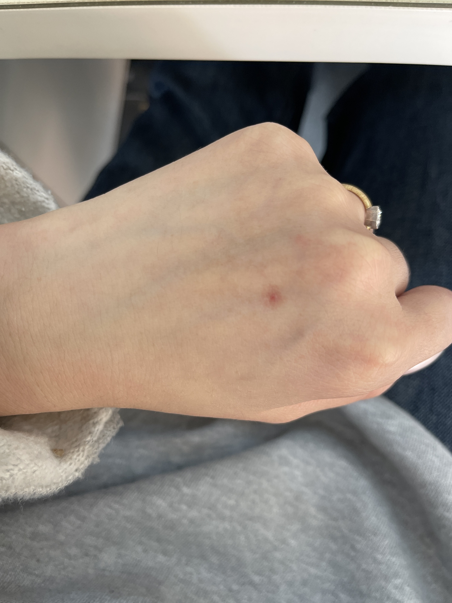 这个是蜘蛛痣吗