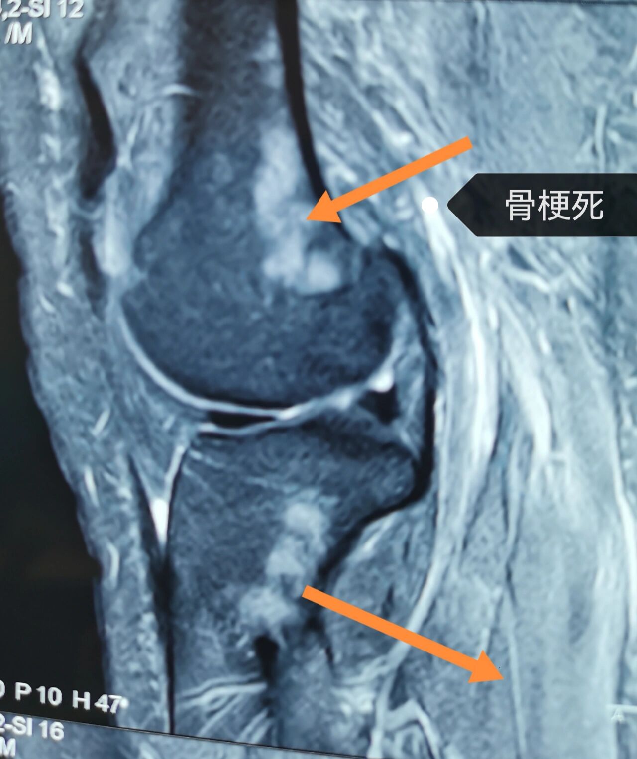 骨梗死的影像 1.