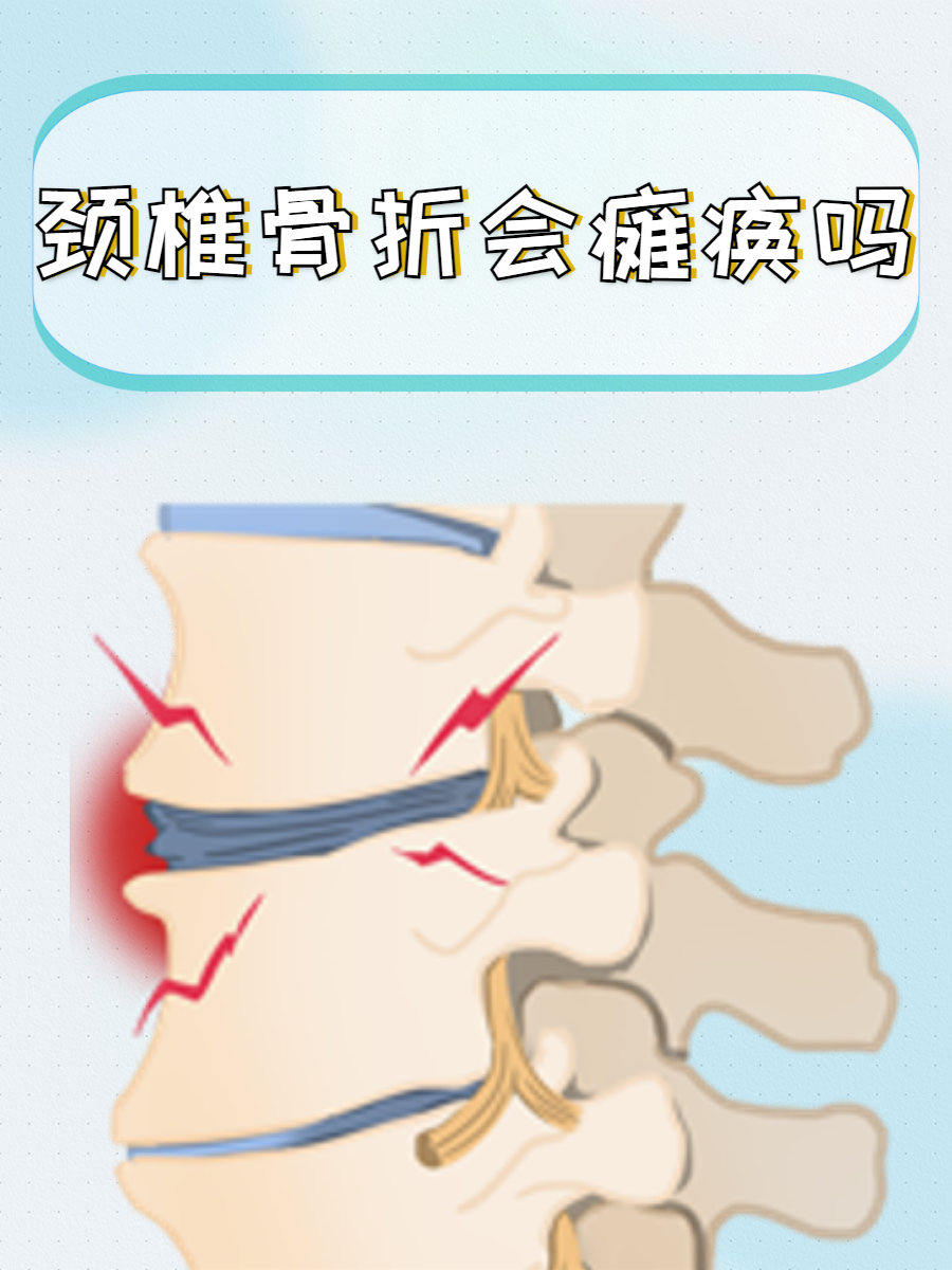 颈椎骨折会瘫痪吗?
