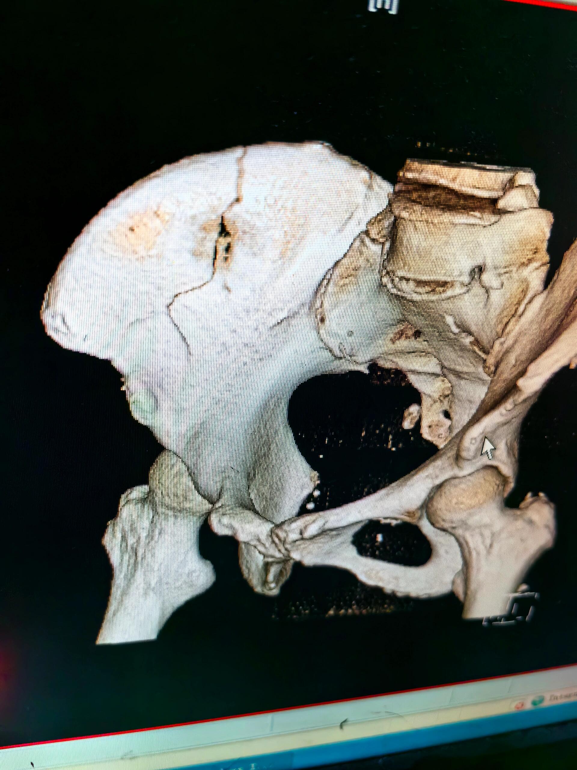 盆骨ct片子图片