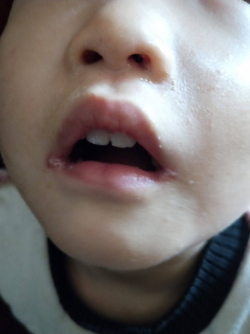 宝宝烂嘴角了,用了一款好物就好了 宝宝嘴角烂了