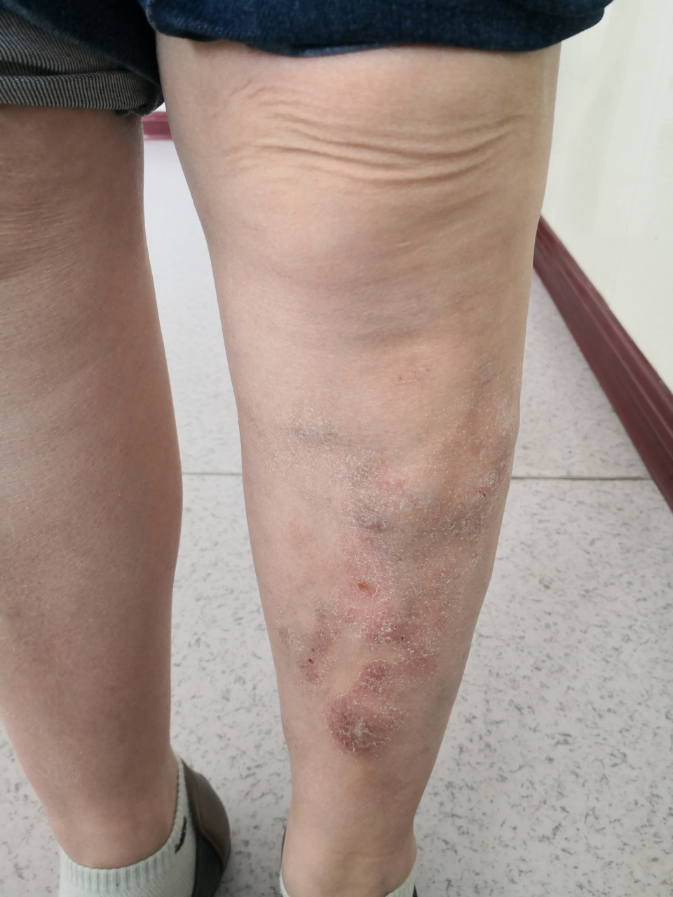 一侧下肢静脉曲张导致的淤积性皮炎症状#过敏##下肢静脉曲张