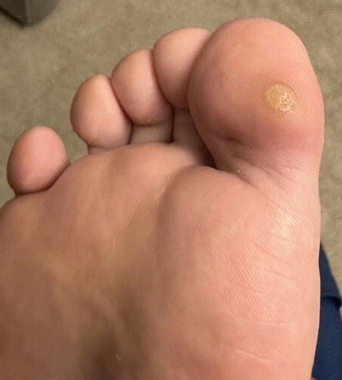 健康美好生活计划# 脚大拇指指腹长了一个疙瘩,约有半年时间,结痂