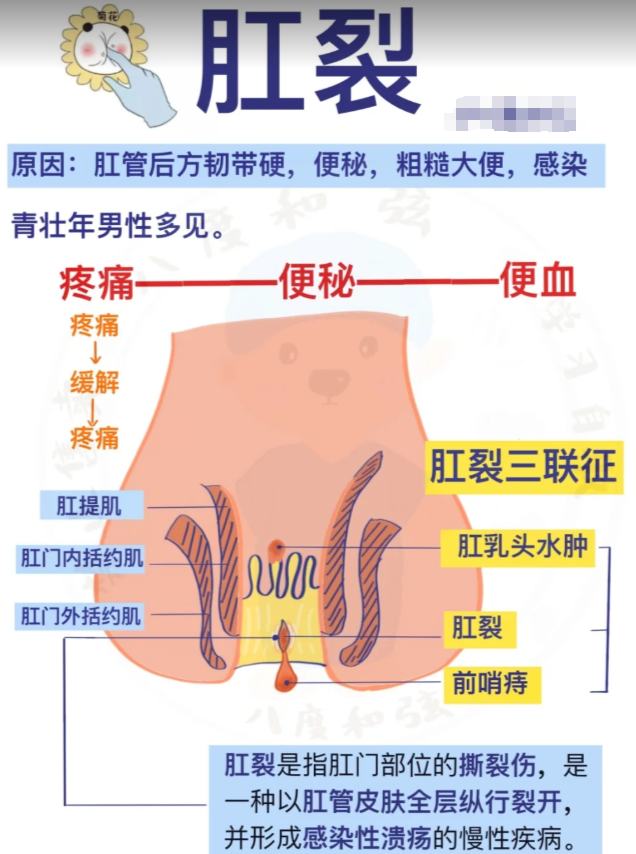 肛裂能不能自愈要看具体情况