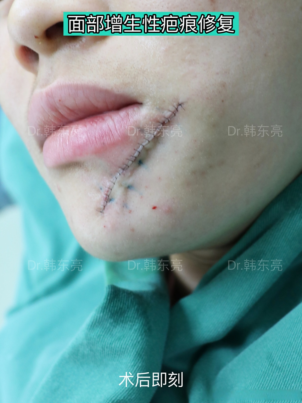 增生性疤痕比较长,凸起明显,还有轻微色素脱失,与周围正常皮肤有明显