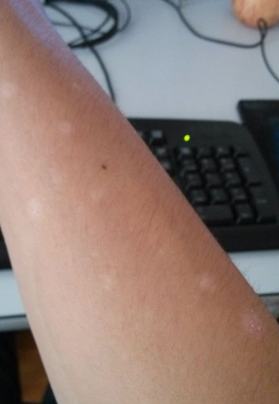 胳膊上出现太阳晒后的小白点,很可能是日光性皮炎