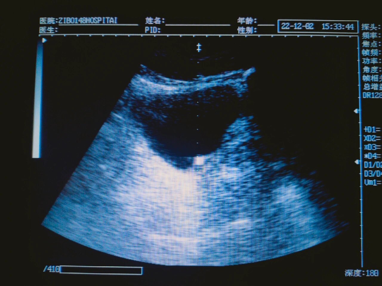 今日复查彩超提示结石排至输尿管末端,给予体外冲击
