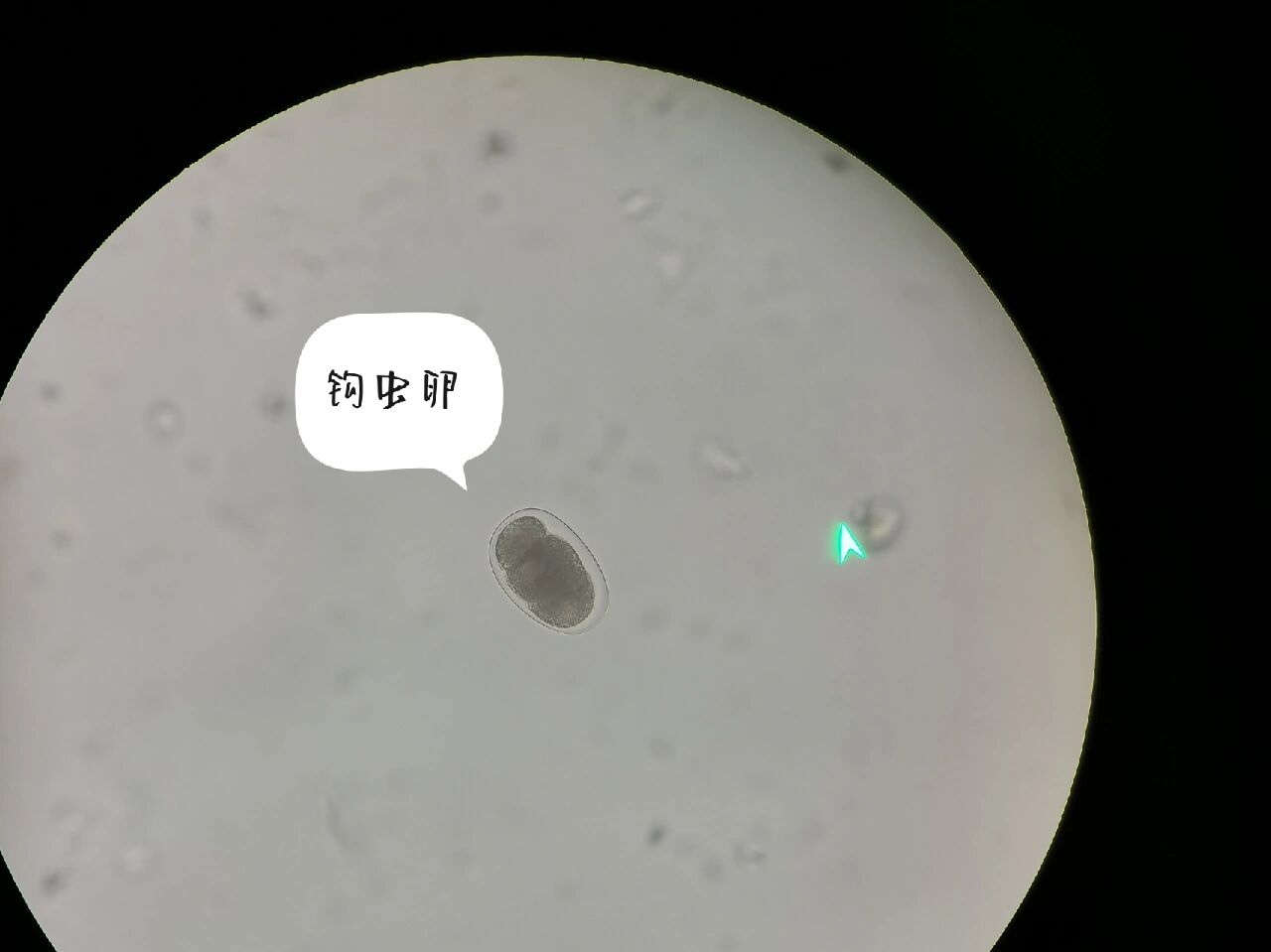 钩虫,鞭虫,旋毛虫虫卵