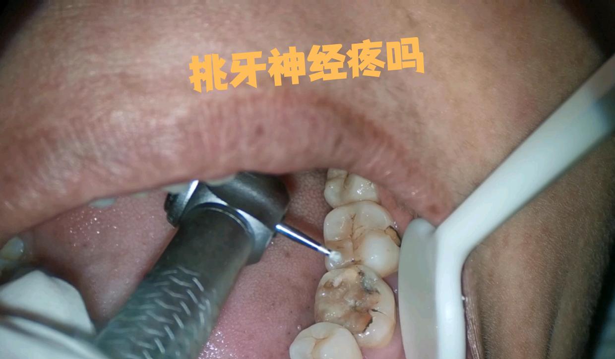 挑牙神经,通常指根管治疗,这一过程中确实可能会引起