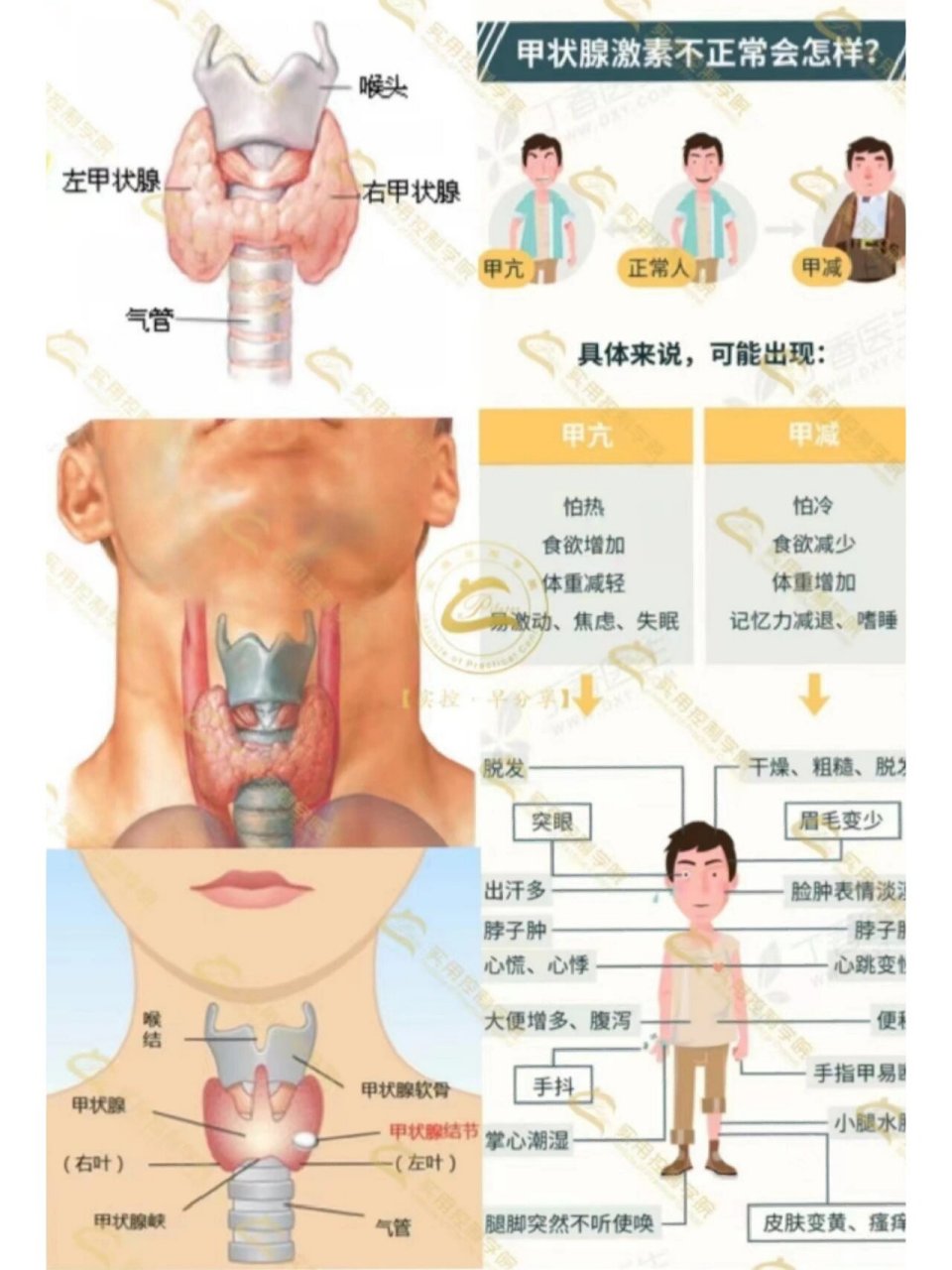 甲状腺分区图图片