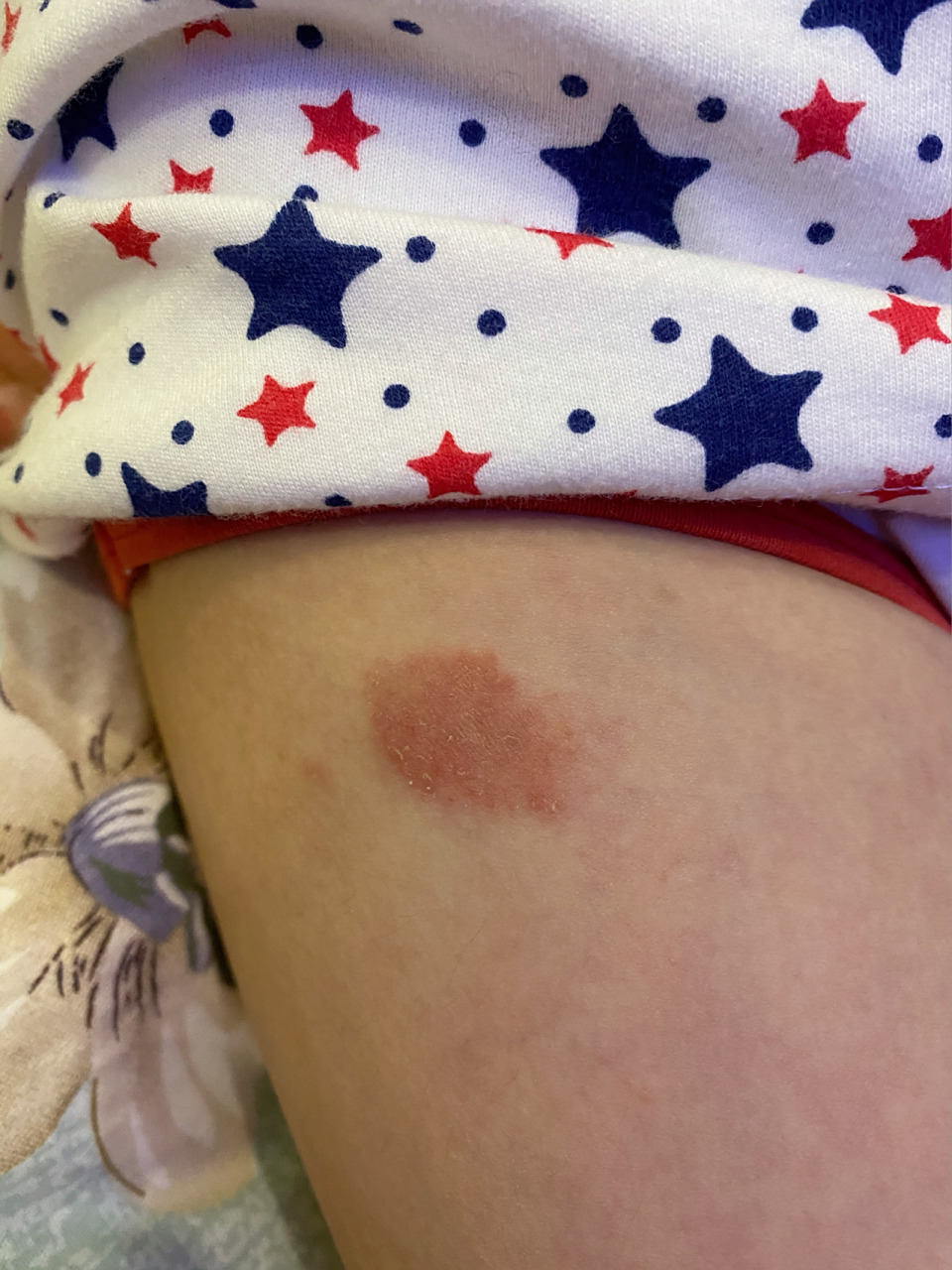 水痘留下的疤怎么去除?