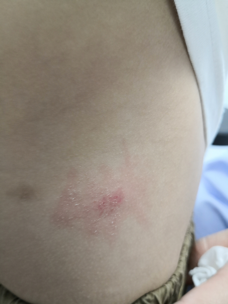 口服药物后出现风团红斑眼睑肿胀#解决皮肤问题专注皮肤美容##过敏