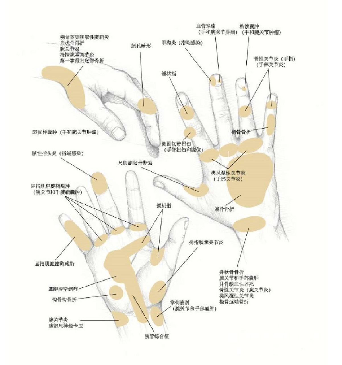 人体手腕关节疼痛及可能疾病示意图! 手腕腕骨痛3个月左右一次