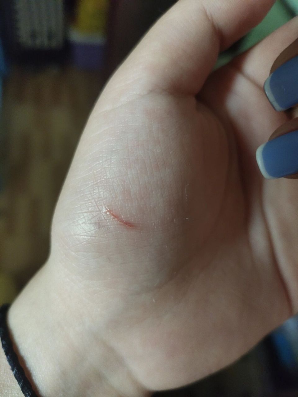 被没有打育苗的小狗牙齿划伤 被小狗的牙齿划伤了,要不要打狂犬疫苗?