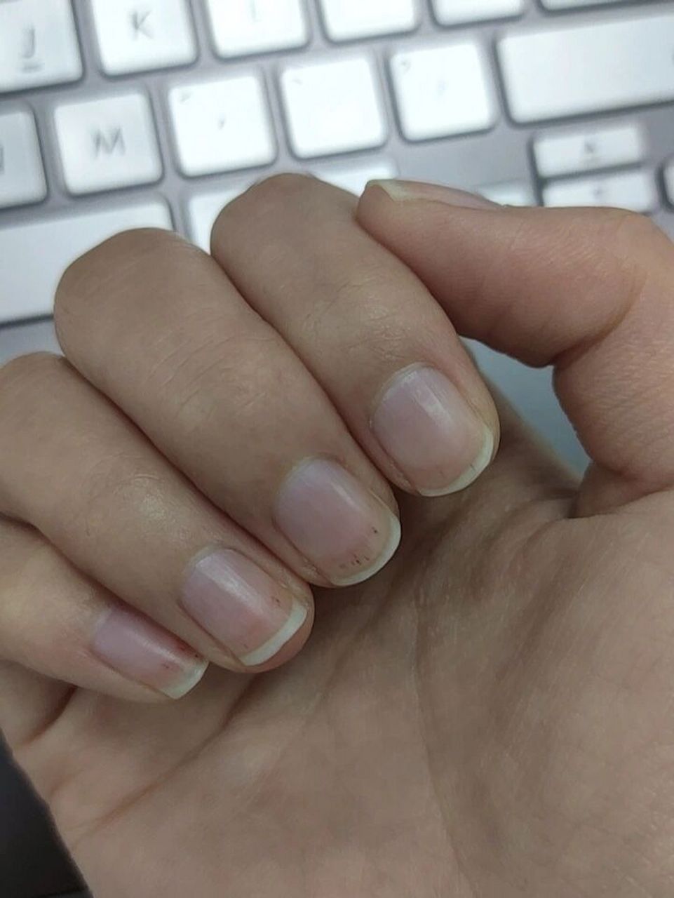 美甲卸甲指甲有黑色竖线 去美甲店里卸了指甲以后,手指甲上多了好多