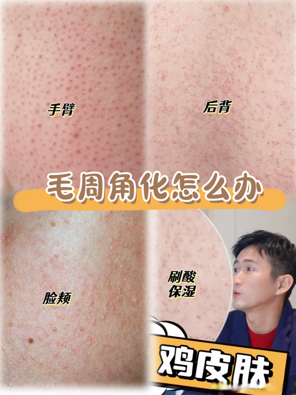 妆点东方##毛周角化怎么办##护肤跟练团#  今天有同学问《毛周角化症 