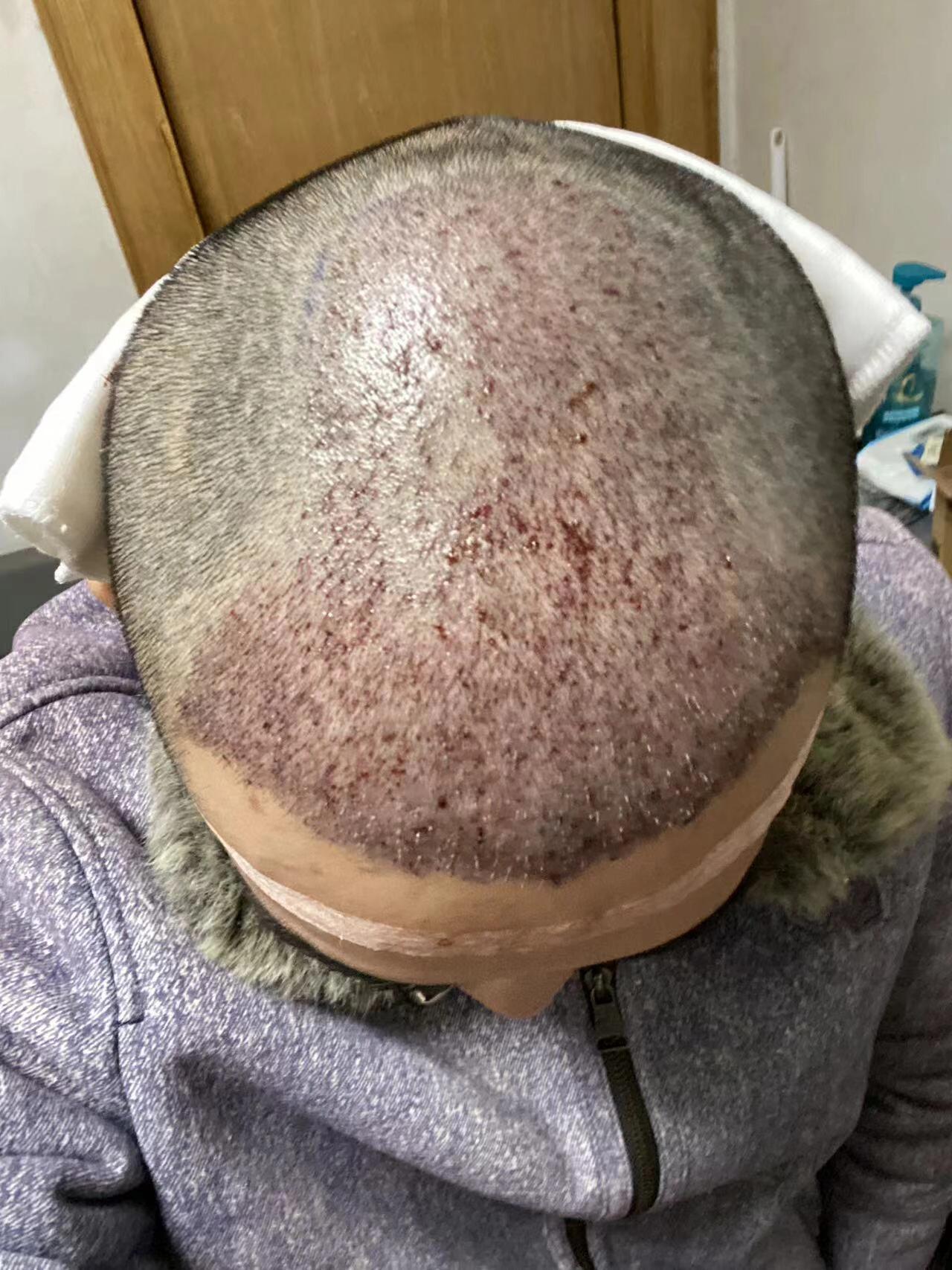 佳美植发曝光(南昌佳美美容医院植发怎么样)
