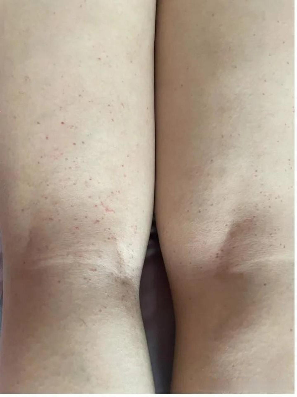 患者自述:过敏性紫癜治疗历程~相信可以治愈的!