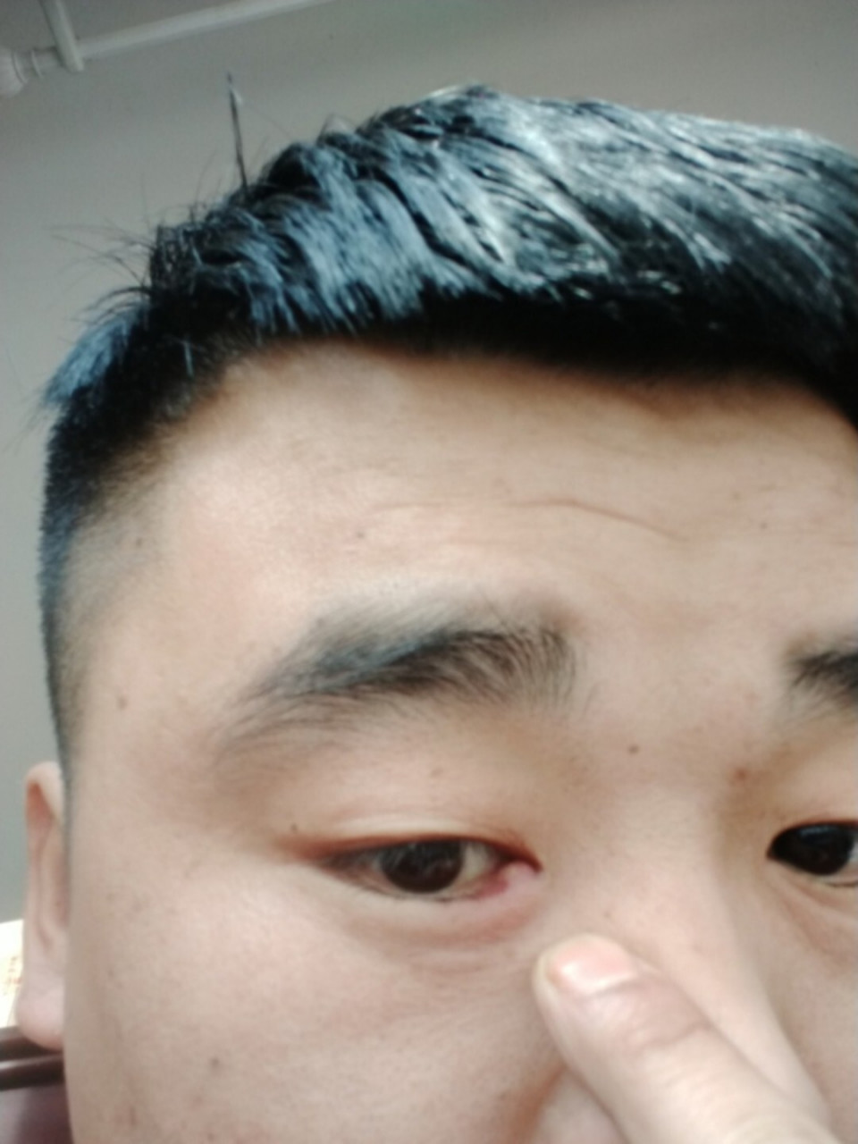 眼角长个肉疙瘩,哪位知道这是什么东西 眼角长个肉疙瘩,哪位知道这是