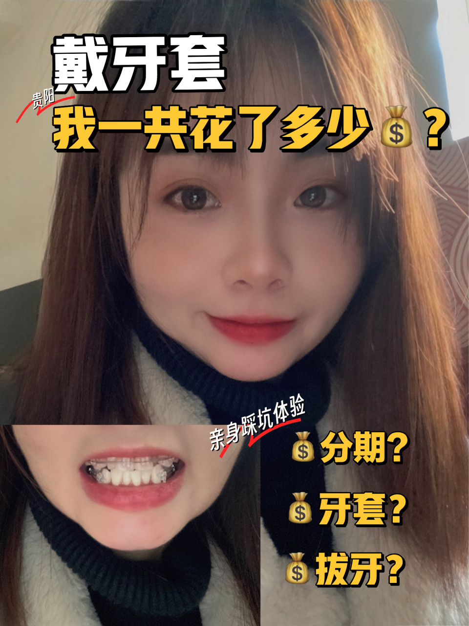 一次性说清楚6015戴牙套73我一共花了多少钱?