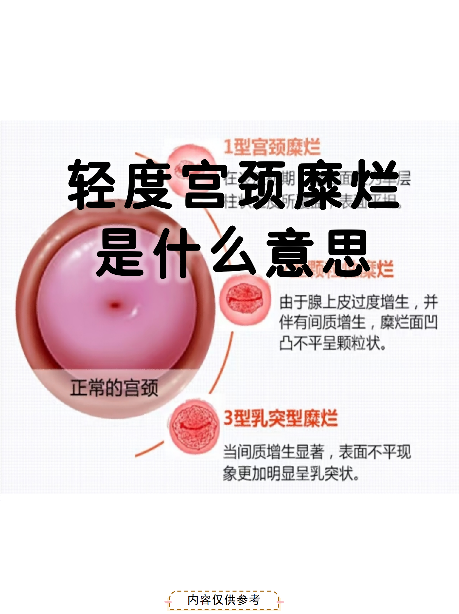 轻度宫颈糜烂是什么意思