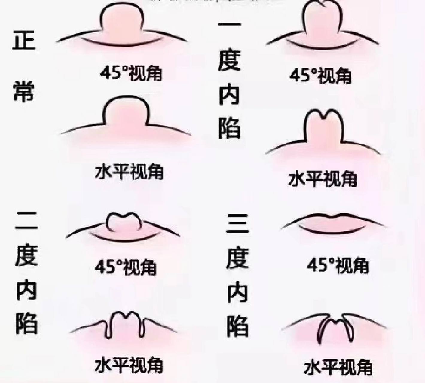 乳头凹陷 乳头凹陷 按照凹陷的程度不同,一般分为三种: (1)一度为部分