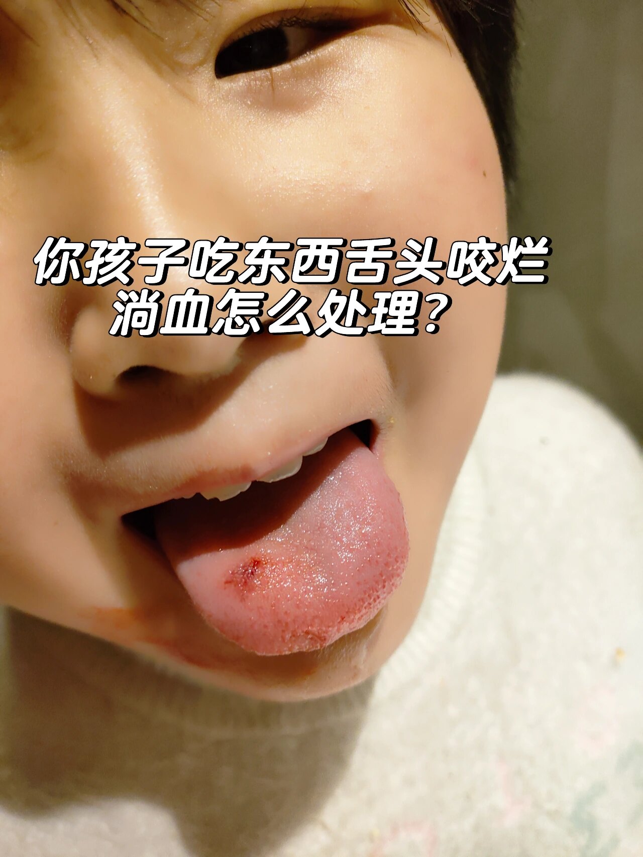 倒霉孩子,孩子吃东西咬烂舌头!