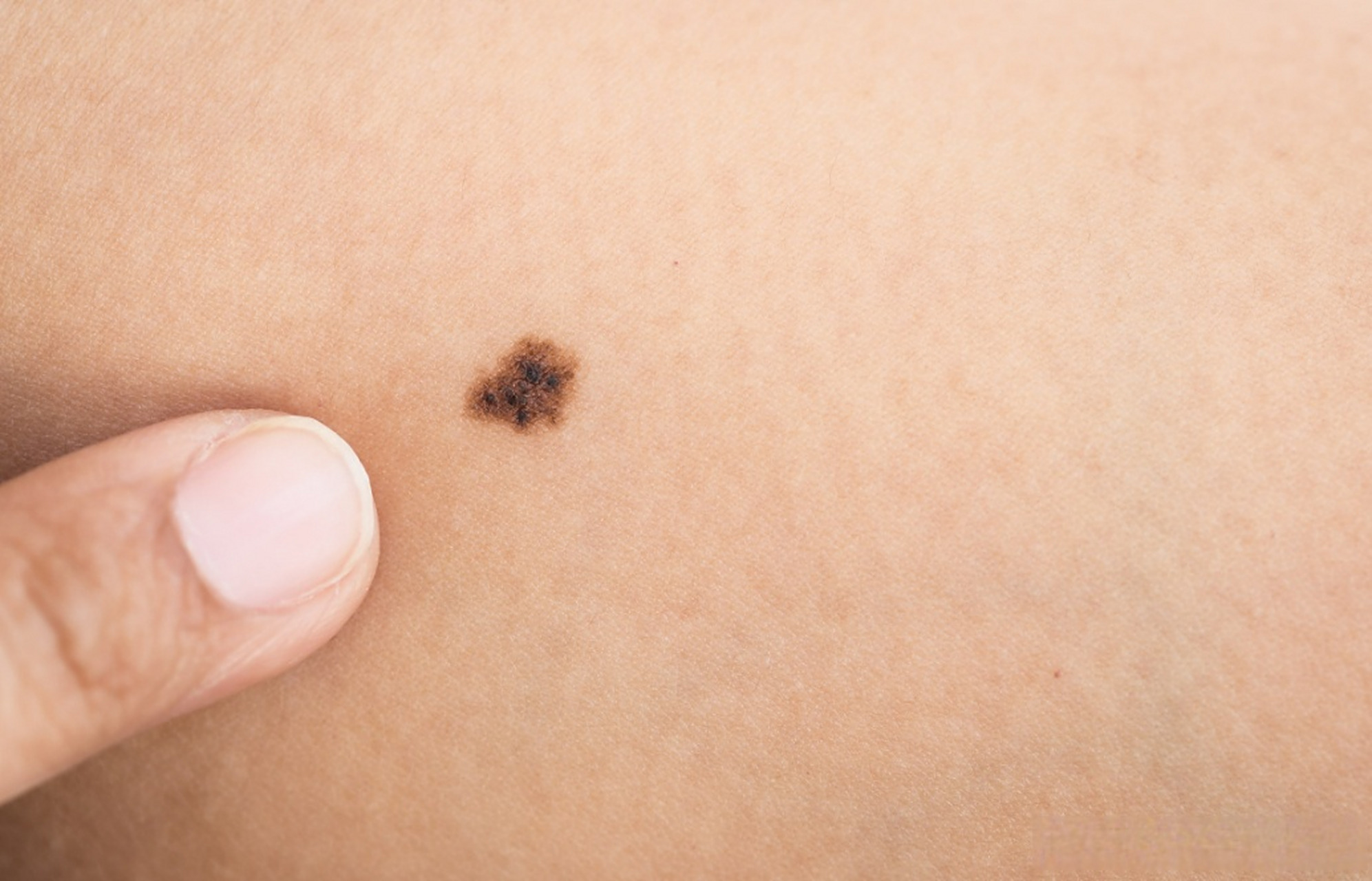 #黑色素瘤# 近些年,黑色素瘤发病率逐年上升.而早期的监测筛查有助于