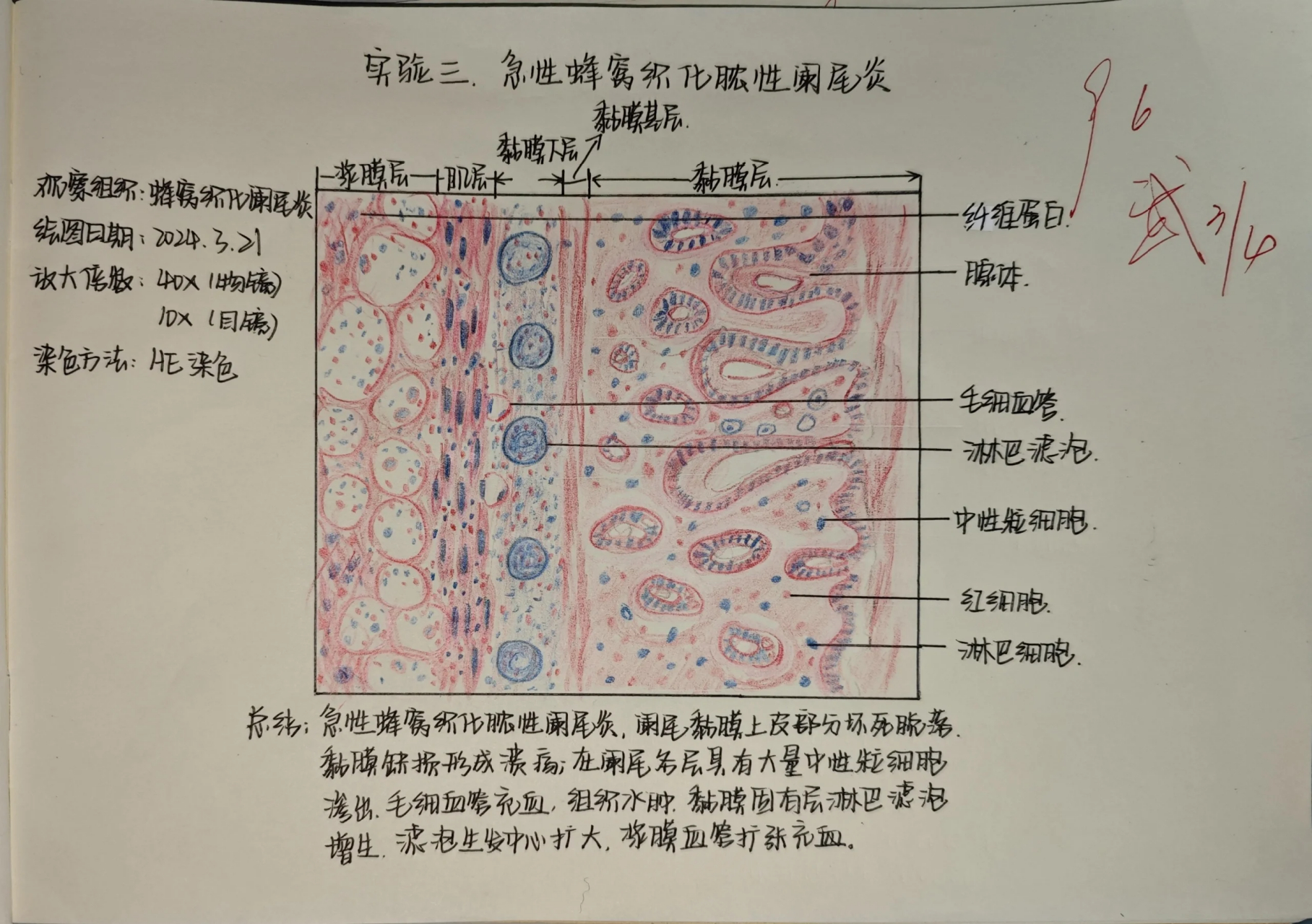 急性蜂窝织化阑尾炎 急性蜂窝织化阑尾炎