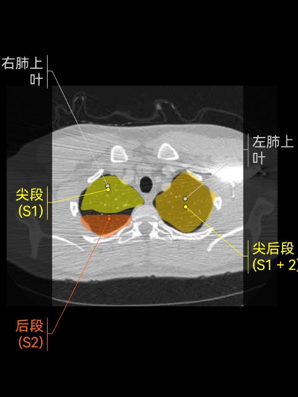 肺的ct分段(高清)|影像学习app 复习基础知识 	 右肺 上叶:s1:尖段;s2
