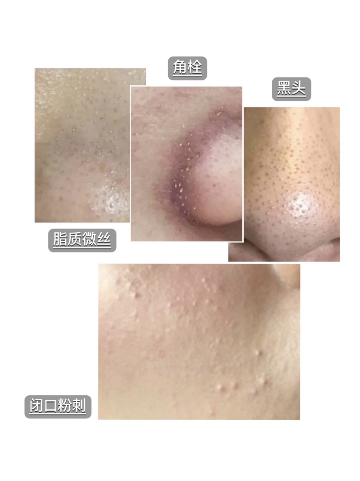 手把手教你去粉刺闭口6015不要挤不要刮74 脂质微丝,角栓,黑头