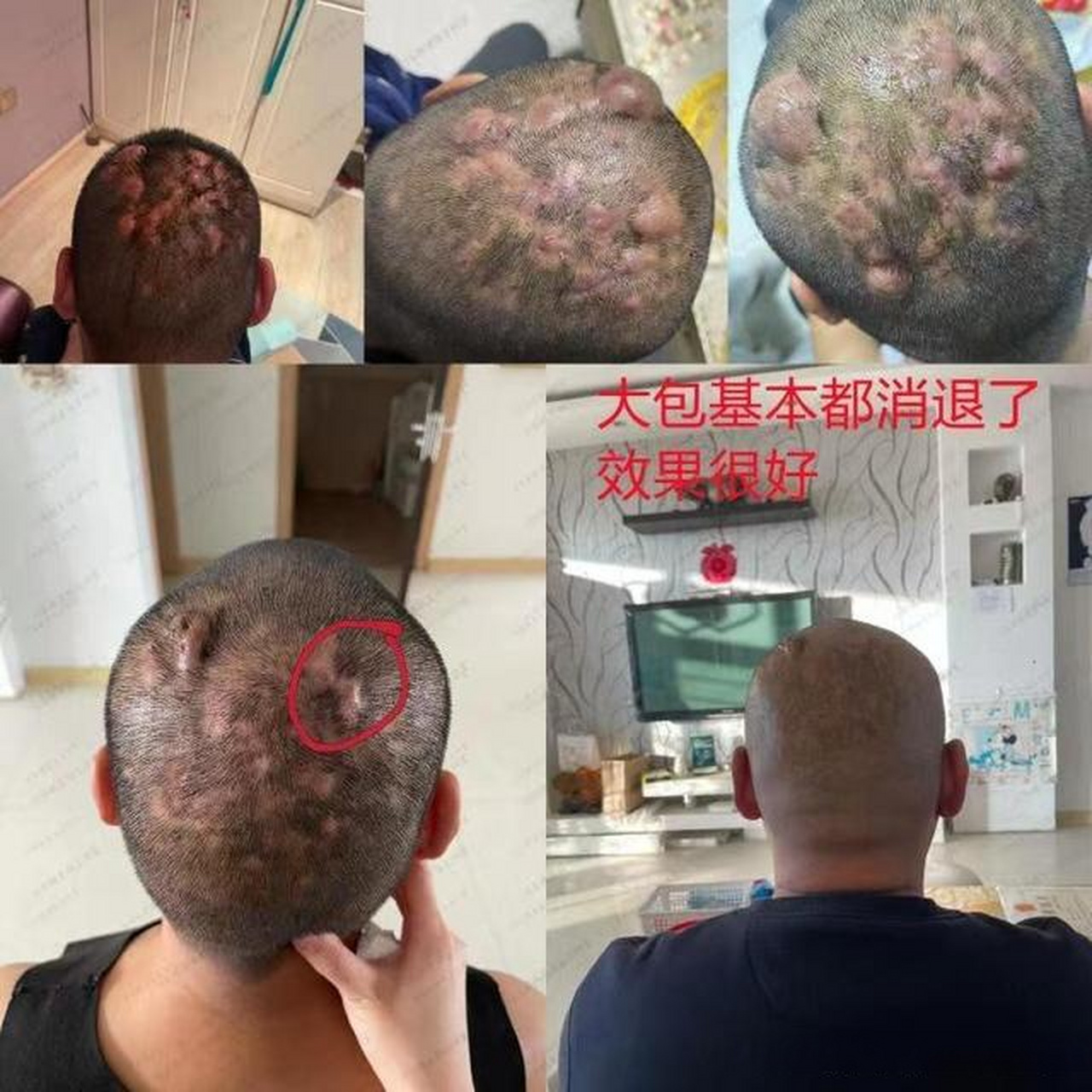 毛囊炎又痛又痒,中医帮您消退它!