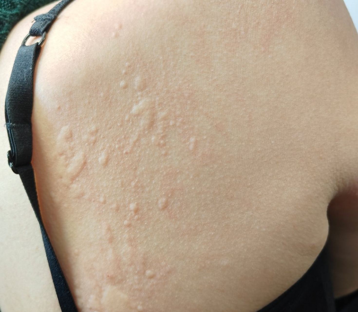 背部荨麻疹症状#过敏