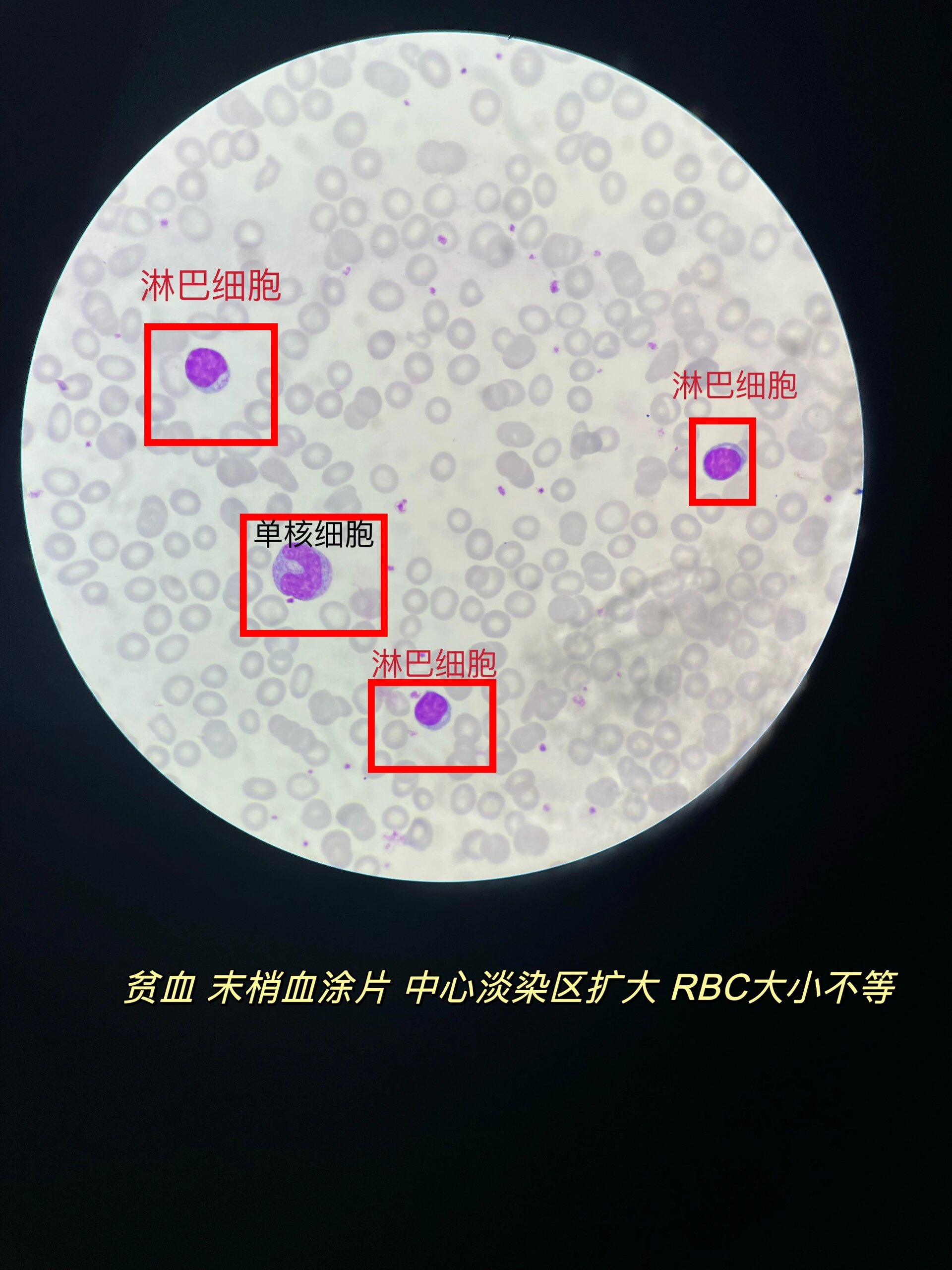贫血的末梢血涂片