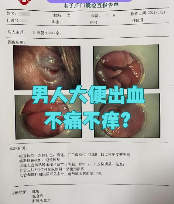 先说痔疮.痔疮分内痔,外痔和混合痔,其中内痔最容易引起这种情况