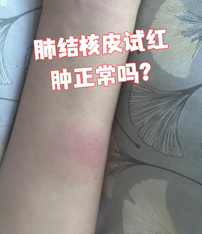 肺结核皮试后出现红肿是正常现象,通常不需要特别处理