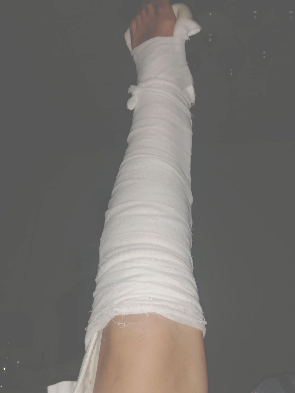 骨折手术后石膏腿痒死了 一到晚上就奇痒无比,怎么办谁能救救我呀!