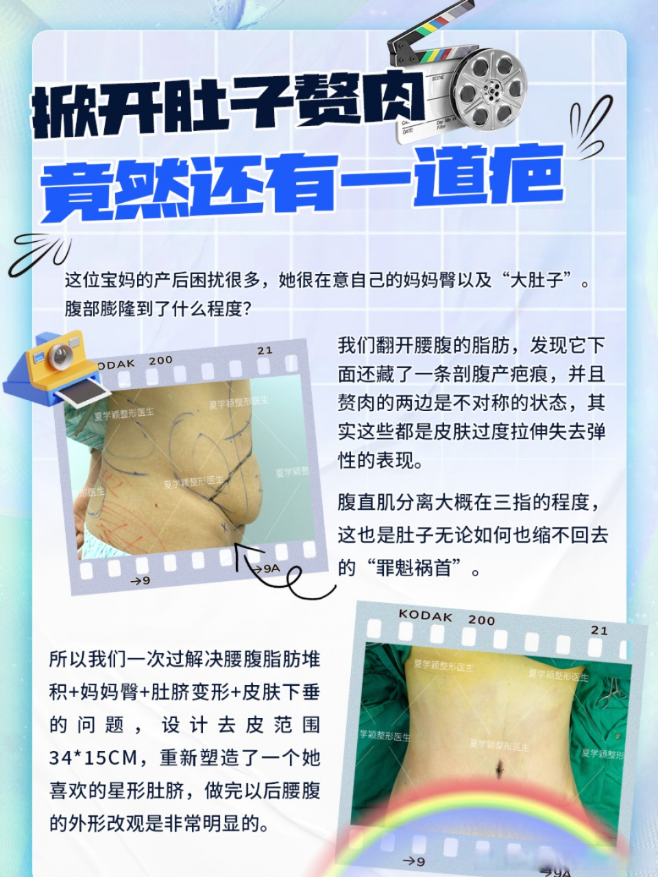 腹壁整形
